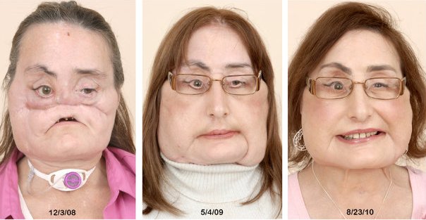 Stages of her surgery